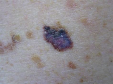 Skin Cancer College Of Anz Journal Updates Melanoma Excision Margins