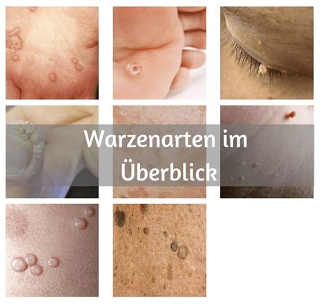 Warzenarten Im Überblick Welche Warze Haben Sie