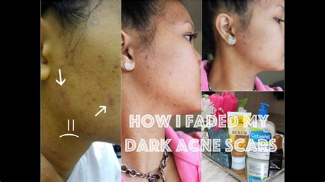 How I Removed My Dark Acne Scars 3 Simple Steps Youtube
