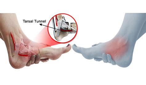 Tarsal Tunnel Syndrome Country Foot Care