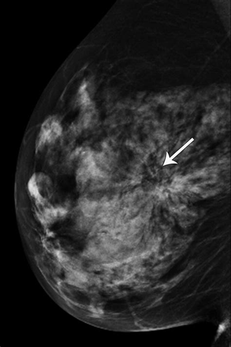 Architectural Distortion On Mammography Correlation With Pathologic