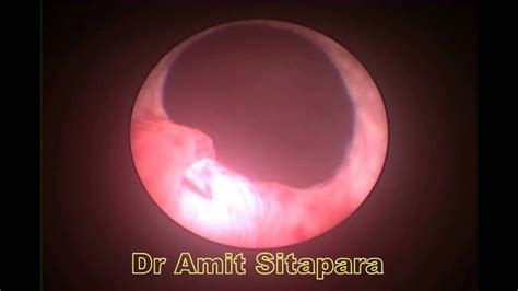 Cystoscopy In Ectopic Ureteric Opening Youtube