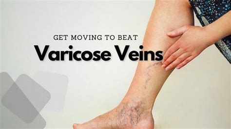 Understanding Varicose Veins Causes And Treatment Options