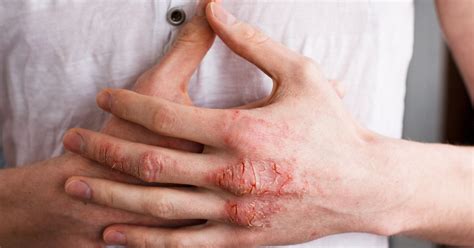 Hand Eczema Symptoms Causes Types And Treatment