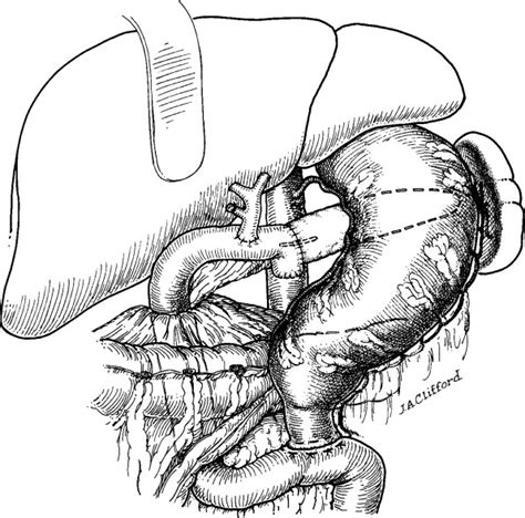 Pylorus Preserving Pancreaticoduodenectomy Longmire Iii Operation