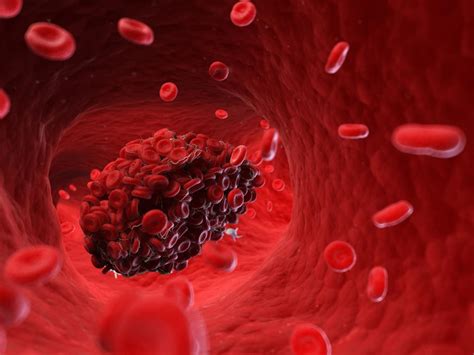 New Imaging Technique To Identify And Treat The Blood Clots