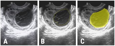 Jpm Free Full Text Ultrasonography In The Differentiation Of