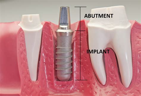 Missing Teeth Treatment In Plano Tx Dental Implants In Allen Tx