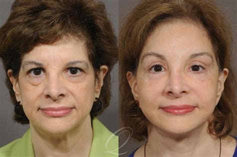Mid Facelift Before After Photo Gallery Serving Rochester Syracuse