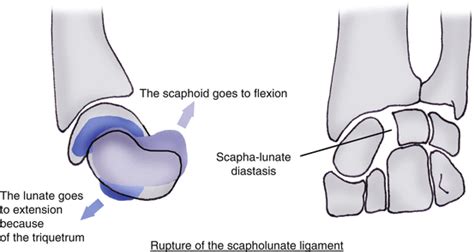 Sprains Of The Scapholunate Ligament Musculoskeletal Key