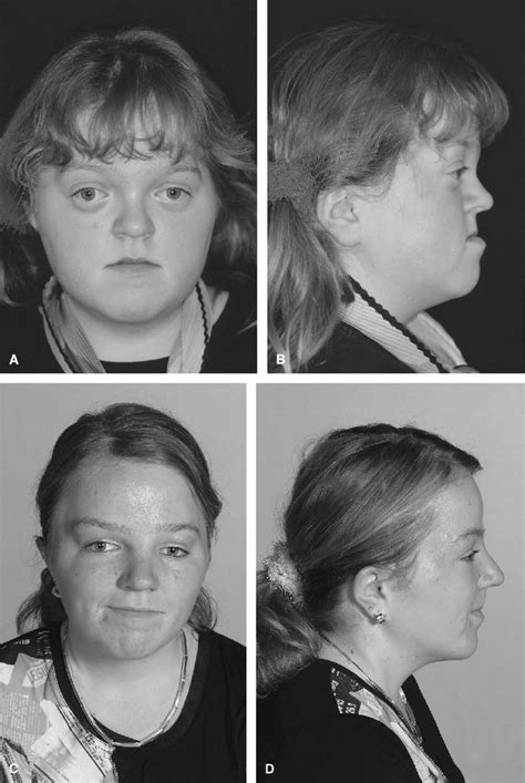 Patient With Crouzon Syndrome And Normal Mental Development Who Had