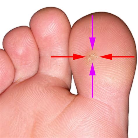 How To Get Rid Of Plantar Warts Balancing Touch Reflexology