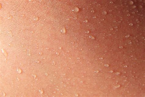 How To Deal With Excessive Sweating The London Dermatologist