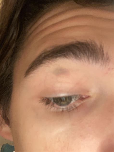 Weird Grayish Spot On Eyelid Appeared Today Not A Bruise And It Doesn
