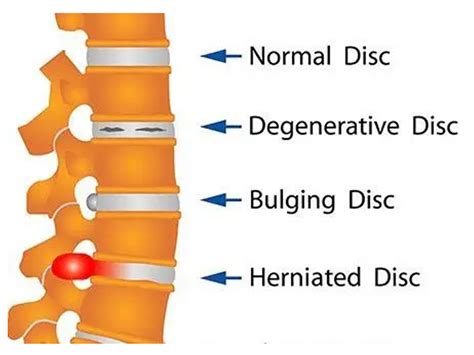 Bulging Disc Vs A Herniated Disc Whats The Difference New York My Xxx