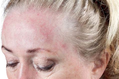 Dermatitis On Face Pictures Symptoms And Pictures
