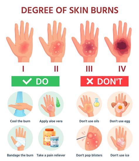 Burns Degree First Aid For Burn Wound Fire Damage To Skin Classifica