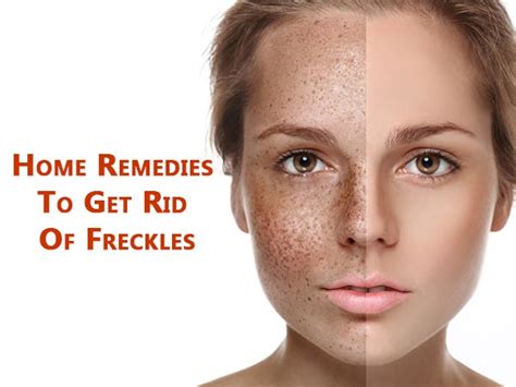 Home Remedies To Get Rid Of Freckles
