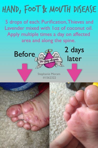 Natural Remedy For Hand Foot And Mouth Disease Just In Case This Is
