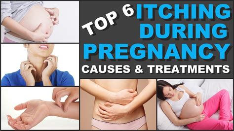 Top 6 Itching During Pregnancy Causes And Treatments Youtube