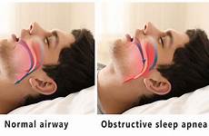 apnea obstructive airway congestion nasal osa cpap apnoea schlafapnoe snore breathing dentistry secondary orthodontic sleeping tidur cardiovascular signs symptoms risk