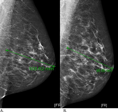 Low Energy Mammogram Obtained In Contrast Enhanced Digital Mammography
