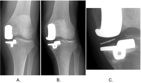 Meniscal Bearing Dislocation While Rolling Over In Sleep Following