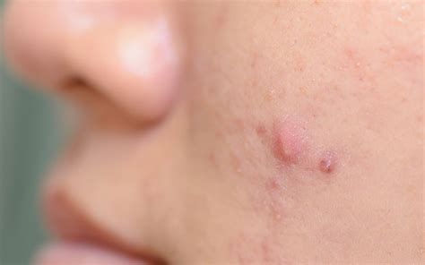 How To Treat Acne Papules With Ayurvedic Remedies Vedix