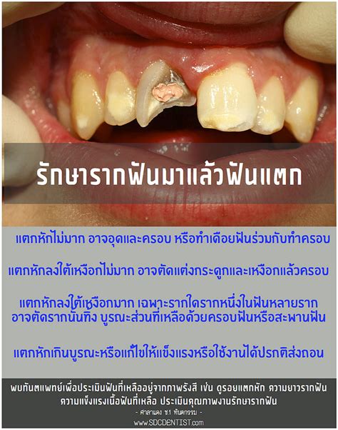 4 สิ่งห้ามพลาด หลังรักษารากฟัน ด้วยประการทั้งปวง