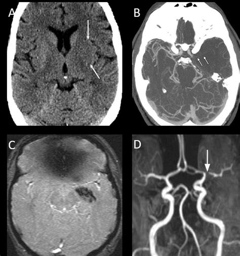 Non Contrast Ct And Mri In Ischemic Stroke A Non Contrast Ct Scan B