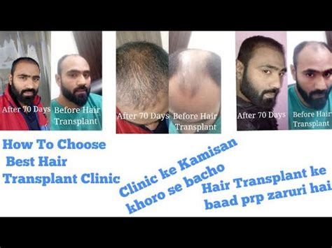 How To Chose Best Hair Transplant Clinic Aftr Hair Transplant Kya Prp