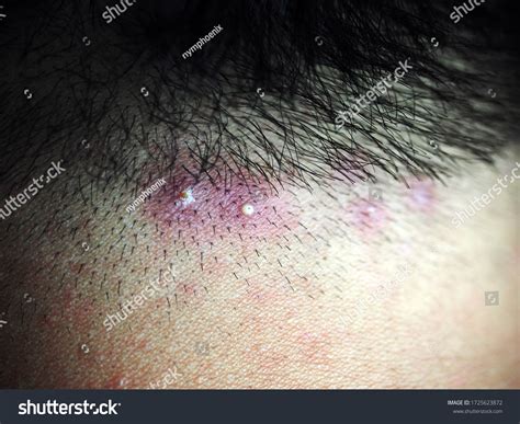 Inflamed Pus Pimples On Head Scalp Stock Photo 1725623872 Shutterstock