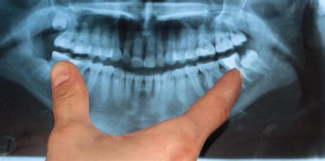 What Is Jaw Bone Cancer With Pictures