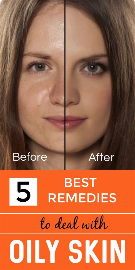 Oily Face Can Be Easily Dealt With These 5 Super Effective Home Remedies Skincaretips Diyskin