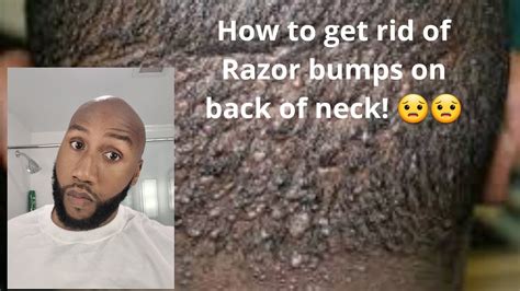How To Get Rid Of The Razor Bumps On The Back Of My Neck Itchy