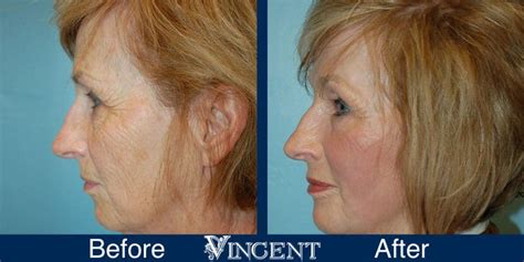 Vincent Surgical Arts Fat Transfer Facelift In Cottonwood Heights