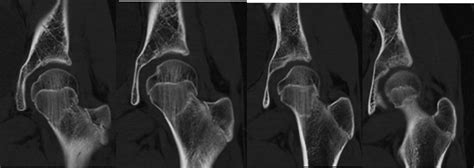 Valgus Impacted Fracture Of Neck Of Femur In A 12 Year Old Child Bmj