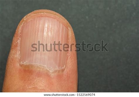 Vertical Ridges On Fingernails Symptoms Deficiency Foto De Stock