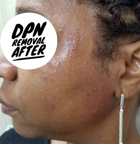 Before And After Dpn Removal Aglow Dermatology
