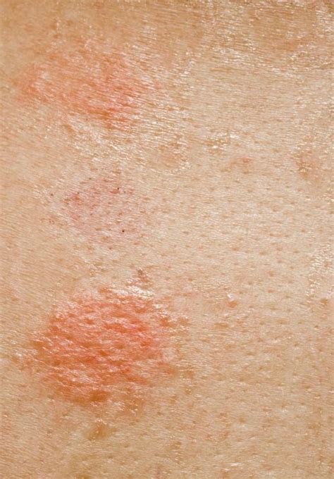 Identifying 21 Common Red Spots On Skin Universal Der Vrogue Co