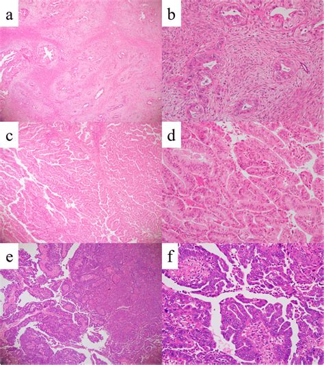 Representative Images Of Mucinous Carcinoma Mc With Infiltrative