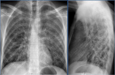Interstitial Pneumonia Vs Bronchopneumonia