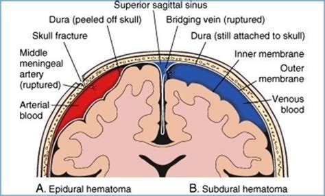 There is only a shin ds, hwang sc; Differences between subdural and epidural hematoma ...