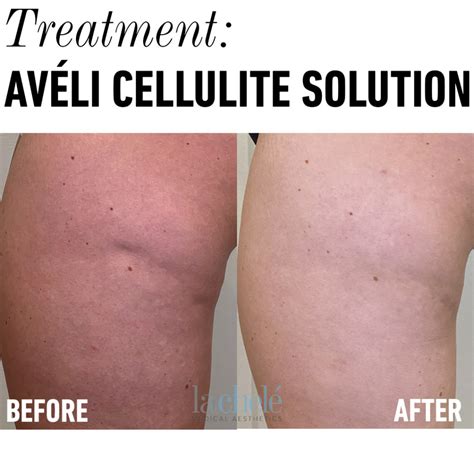 Avéli Cellulite Solution La Chele Medical Aesthetics Llc