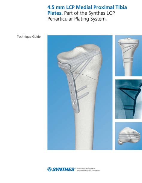 Synthes Distal Tibial Plates