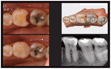 Digital Dentistry Begins With Intraoral Scanning Decisions In Dentistry