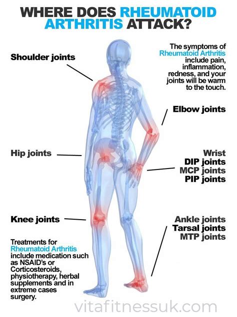 Do You Know About What Is Rheumatoid Arthritis And Its Signs And