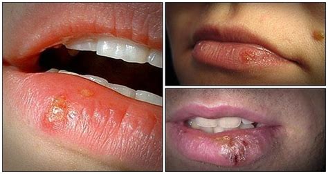 Pictures of herpes reveal a range of symptoms. Useful Tips on How to Get Rid of a Cold Sore | Cold sore, Heal cold sores fast