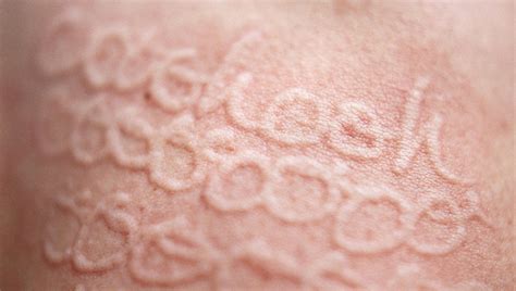 If You Have This Condition You Can Write On Your Skin—no Pen Required