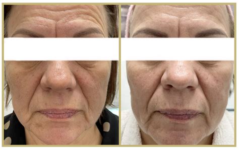 Microneedling Bedford Focus Dual Nue Skin And Laser Clinic